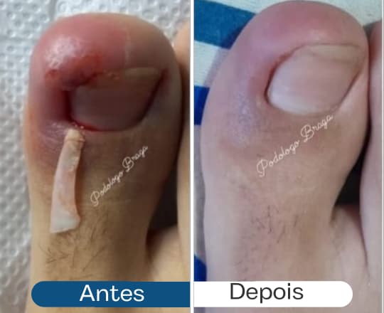 Antes de depois 2