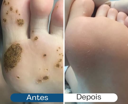 Antes e depois 1