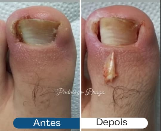 Antes e depois 5