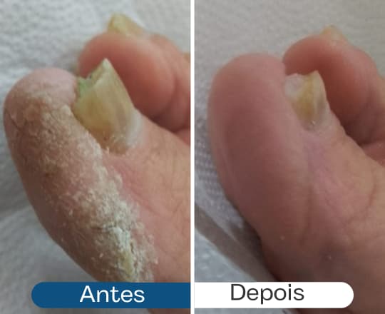 Antes e depois